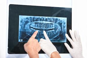an image of a dental x-ray | Deerfield NH dental X-rays