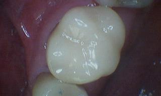 Crowns-After-Image