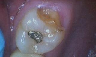 Crowns-Before-Image